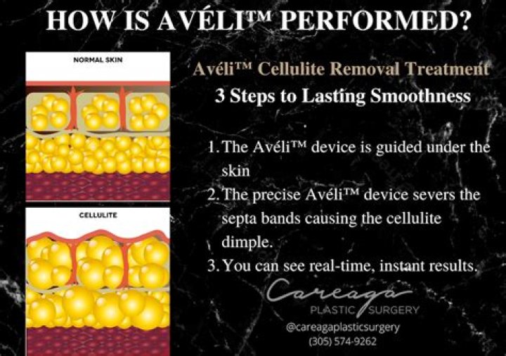 Avéli Is a New FDA-Cleared Treatment for Cellulite—Here's What You Should Know