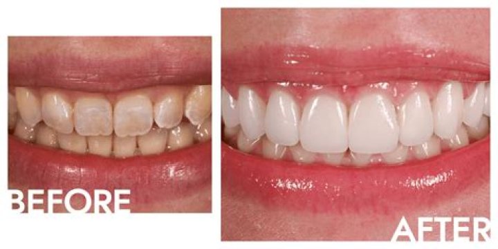 I Had a Combination of Gum Contouring, Teeth Whitening, and Veneers to Achieve My Dream Smile