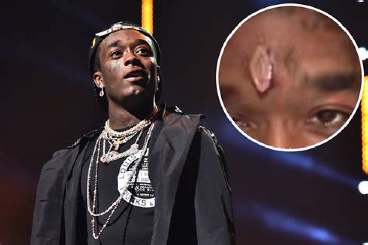 Lil Uzi Vert's $24 million forehead diamond ripped out by fan